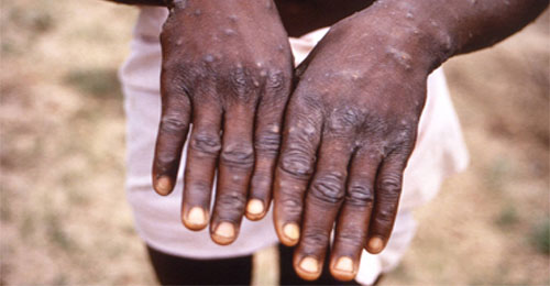 Urgent need for measures against monkey pox 