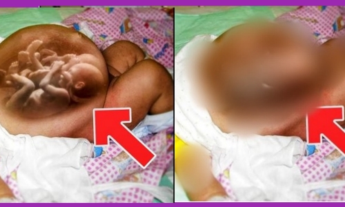 Baby Girl Born Pregnant with Twins