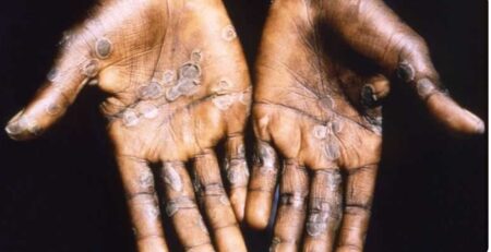 Two new Mpox cases recorded in Accra